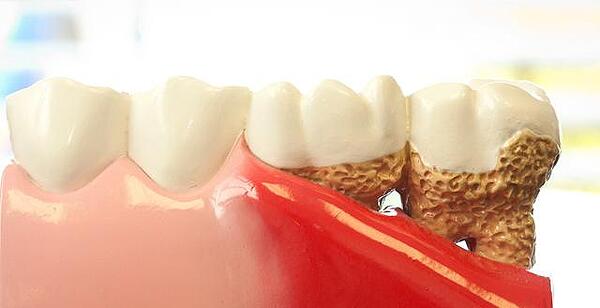 БАКТЕРИИ - ПРИЧИНАТА ЗА ПАРОДОНТОЗАТА