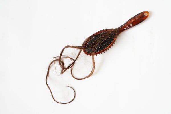 Причини и симптоми на Алопеция Ареата: 9 естествени начини за лечение на косопад